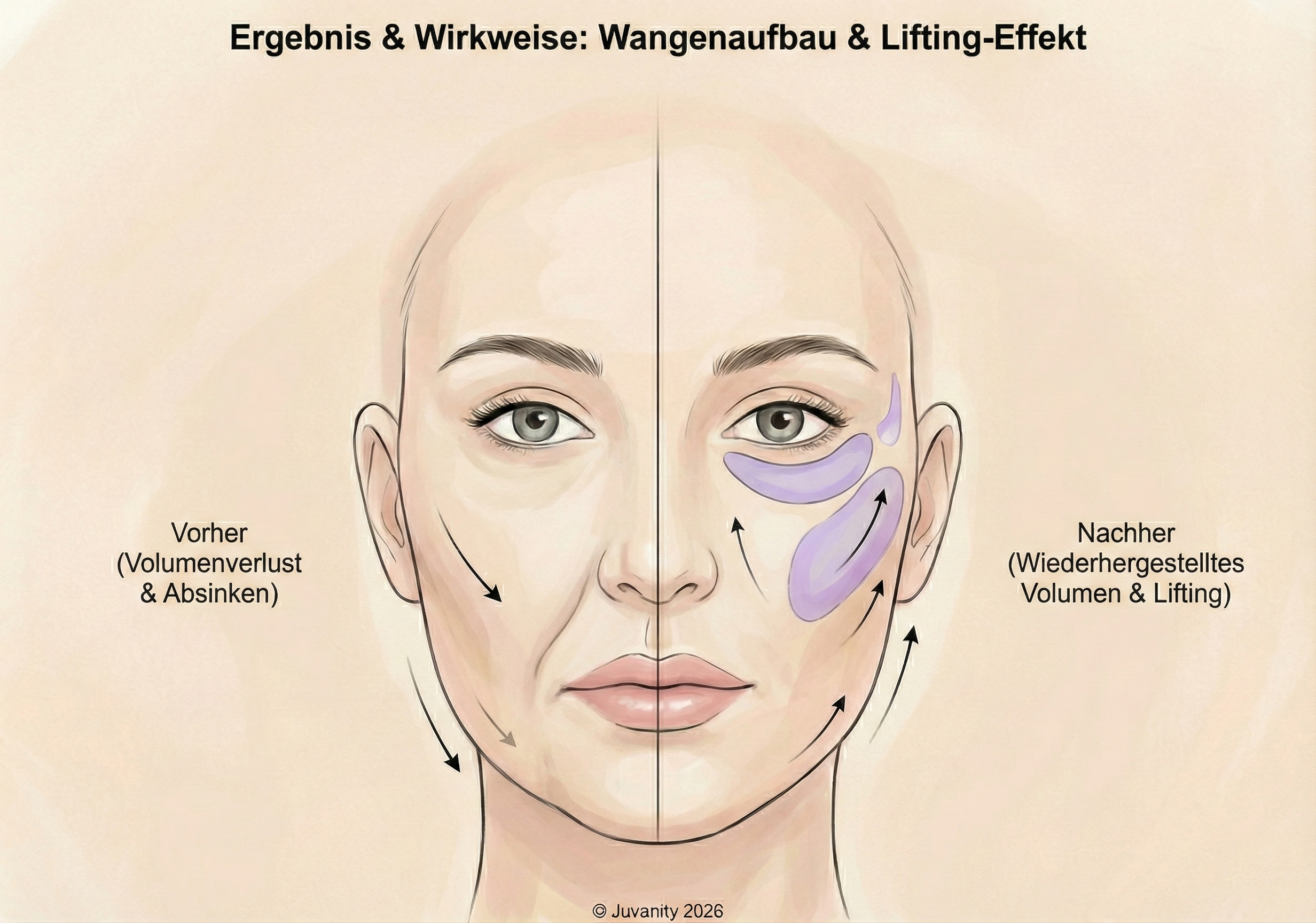 Schematische Darstellung der Wirkweise von Wangenaufbau und Lifting-Effekt © Juvanity 2026