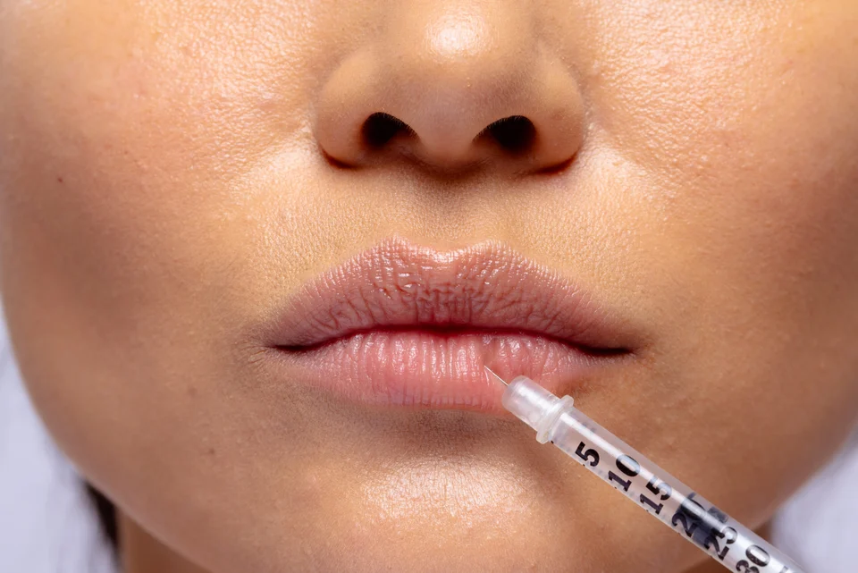 Herpes nach einer Lippenunterspritzung: Risiko, Vorbeugung und Warnzeichen