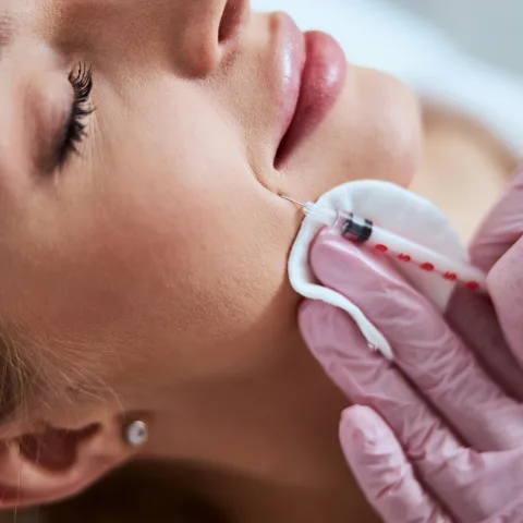 Faltenunterspritzung mit Hyaluron bei Juvanity