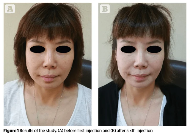Vitamin-C-Glutathion-Infusion in Lampertheim: Glow, Hautbild und Skin Whitening – was sagt die Studie?