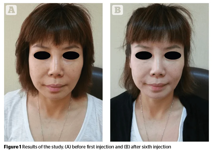 Vitamin-C-Glutathion-Infusion in Lampertheim: Glow, Hautbild und Skin Whitening – was sagt die Studie?