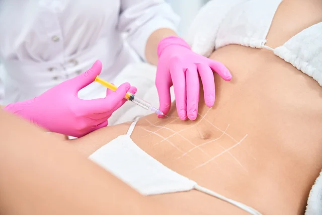Cellulite-Spritze Viernheim – diskret & ohne OP