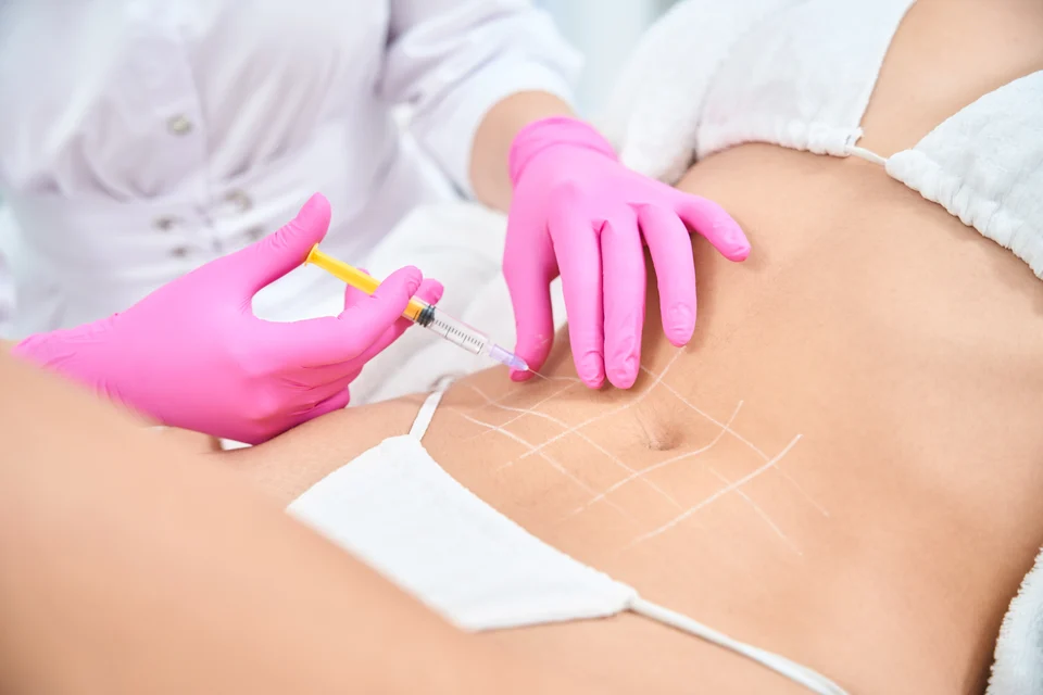 Cellulite-Spritze Viernheim – diskret & ohne OP