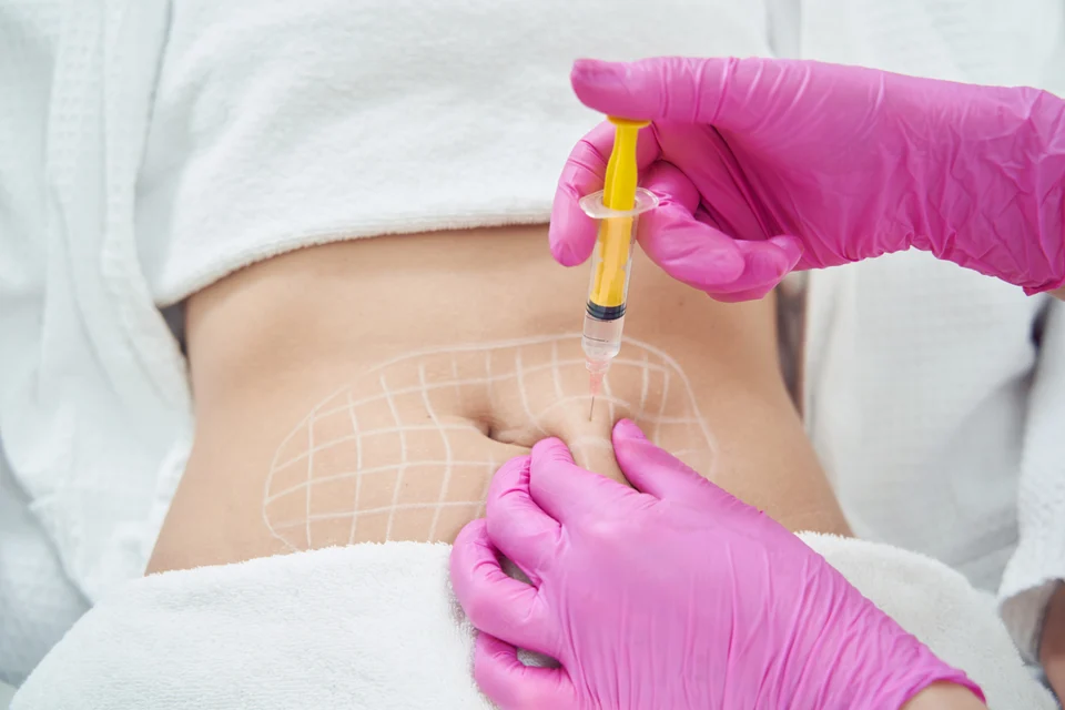 Cellulite-Spritze Lampertheim – Alidya™ gegen Orangenhaut