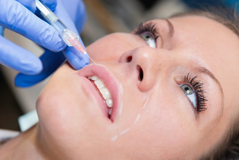 Ästhetische Behandlung – Welche Falten lassen sich mit Hyaluron behandeln?