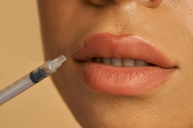 Lippenbehandlung – Lippenunterspritzung Viernheim – natürlich volle Lippen mit Hyaluron