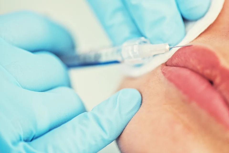 Lippenbehandlung – 0,5 ml oder 1 ml Hyaluron für die Lippen – was ist realistisch?
