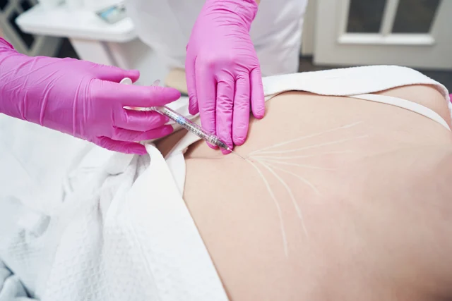 Ästhetische Behandlung – Skinbooster, Polynukleotide, PDLLA… Welches Treatment braucht Ihre Haut wirklich?