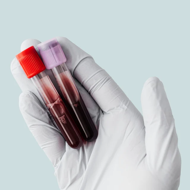 Labordiagnostik – Eisenmangel beheben: Wenn Eisentabletten nicht vertragen werden