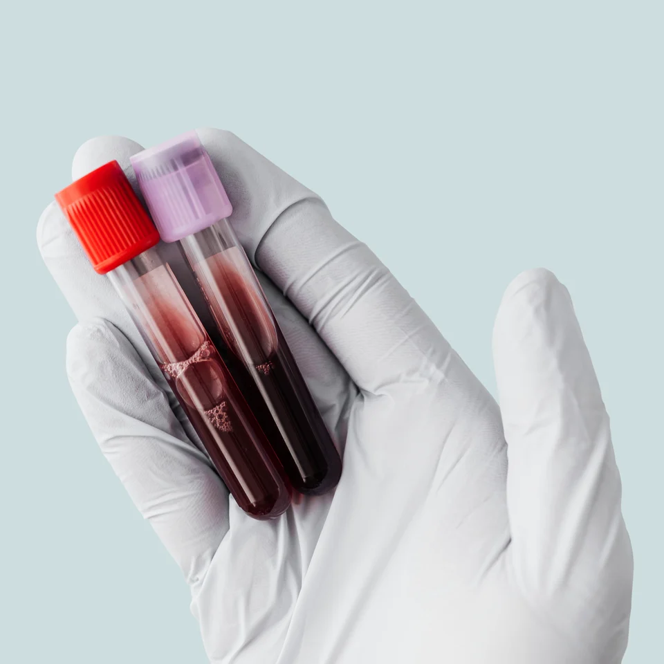 Labordiagnostik – Eisenmangel beheben: Wenn Eisentabletten nicht vertragen werden