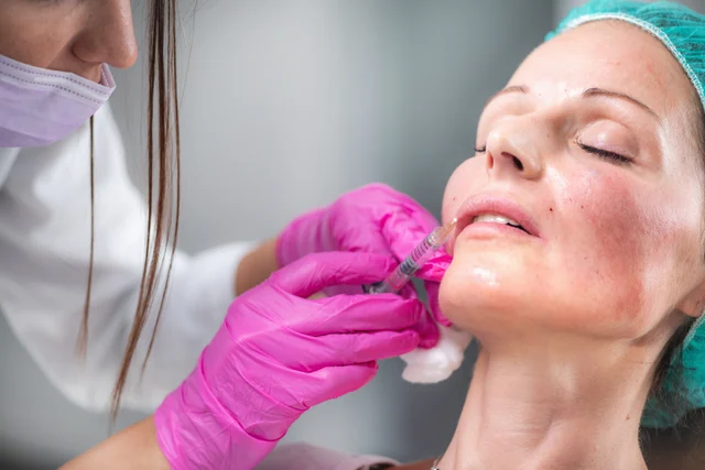 Lippenbehandlung – Lippenunterspritzung Bensheim – natürlich volle Lippen mit Hyaluron