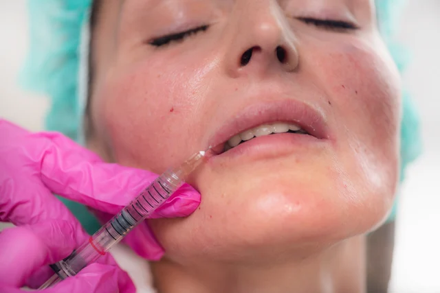 Lippenbehandlung – Lippenunterspritzung Biblis – natürlich volle Lippen mit Hyaluron