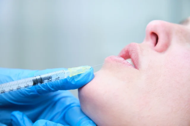 Lippenbehandlung – Lippenunterspritzung Frankenthal – natürlich volle Lippen mit Hyaluron