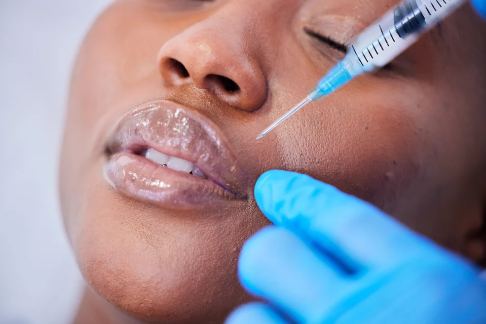 Lippenbehandlung – Lippen aufspritzen in Lampertheim: Warum Sie für volle Lippen nicht nach Mannheim oder Frankfurt fahren müssen