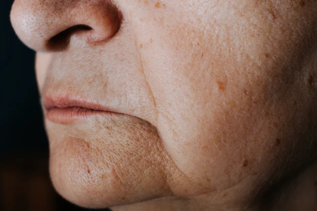 Lippenbehandlung – Nasenkorrektur ohne OP: Was Hyaluron kann – und was nicht